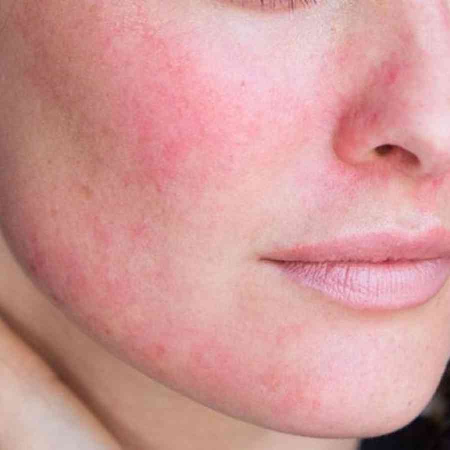 Rosacea: Triggers, Treatment, and Advice
