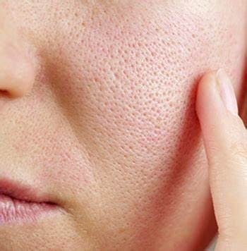 When is it a visible pore and when is it a blackhead?