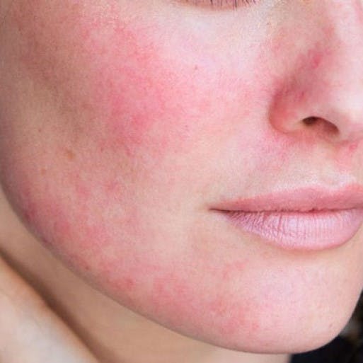 Rosacea: Triggers, Treatment, and Advice